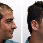 hair transplant price in Ludhiana